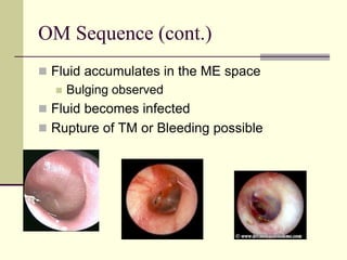 OM Sequence (cont.)
 Fluid accumulates in the ME space
 Bulging observed
 Fluid becomes infected
 Rupture of TM or Bleeding possible
 