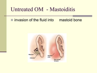 Untreated OM - Mastoiditis
 invasion of the fluid into mastoid bone
 
