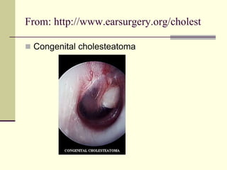 From: http://www.earsurgery.org/cholest
 Congenital cholesteatoma
 