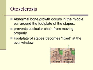 Otosclerosis
 Abnormal bone growth occurs in the middle
ear around the footplate of the stapes.
 prevents ossicular chain from moving
properly
 Footplate of stapes becomes “fixed” at the
oval window
 