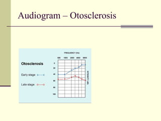 Audiogram – Otosclerosis
 