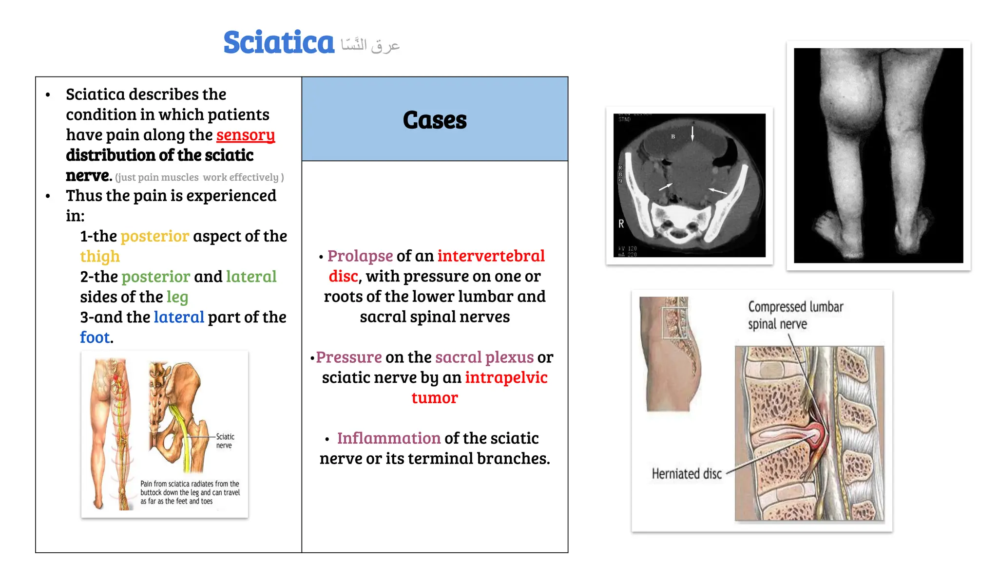 • Sciatica describes the
condition in which patients
have pain along the sensory
distribution of the sciatic
nerve.(just pain muscles work effectively )
• Thus the pain is experienced
in:
1-the posterior aspect of the
thigh
2-the posterior and lateral
sides of the leg
3-and the lateral part of the
foot.
Cases
• Prolapse of an intervertebral
disc, with pressure on one or
roots of the lower lumbar and
sacral spinal nerves
•Pressure on the sacral plexus or
sciatic nerve by an intrapelvic
tumor
• Inflammation of the sciatic
nerve or its terminal branches.
Sciatica ‫ّﺎ‬‫ﺴ‬‫ﱠ‬‫ﻨ‬‫اﻟ‬ ‫ﻋﺮق‬
 
