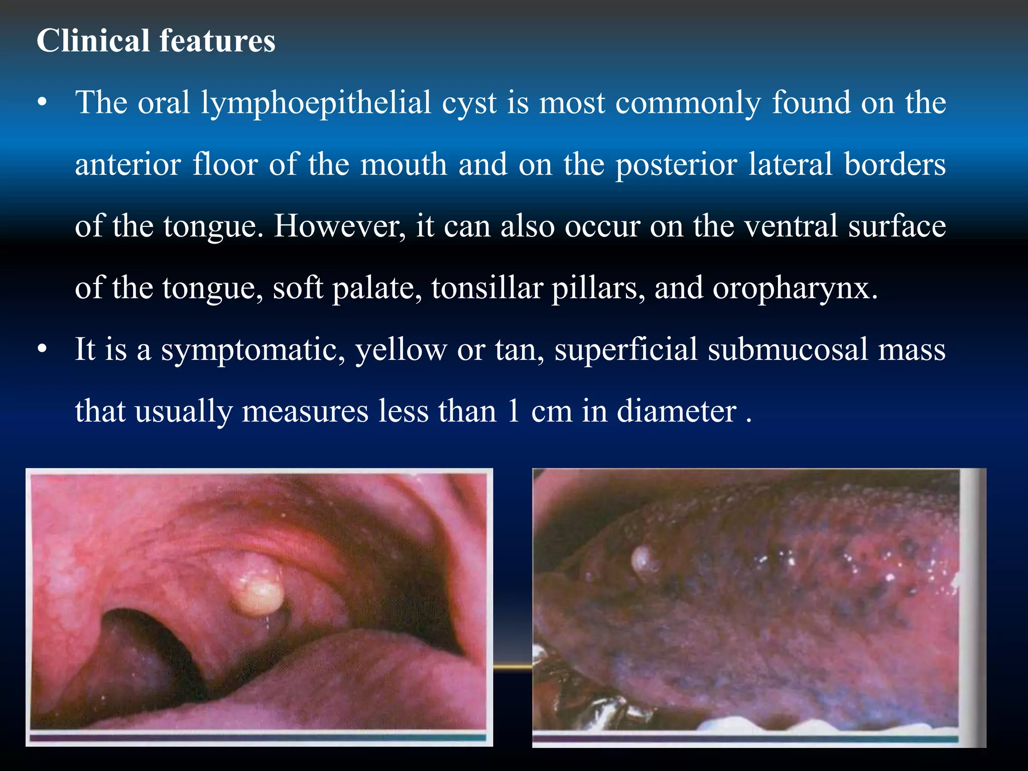 Clinical features
• The oral lymphoepithelial cyst is most commonly found on the
anterior floor of the mouth and on the posterior lateral borders
of the tongue. However, it can also occur on the ventral surface
of the tongue, soft palate, tonsillar pillars, and oropharynx.
• It is a symptomatic, yellow or tan, superficial submucosal mass
that usually measures less than 1 cm in diameter .
 