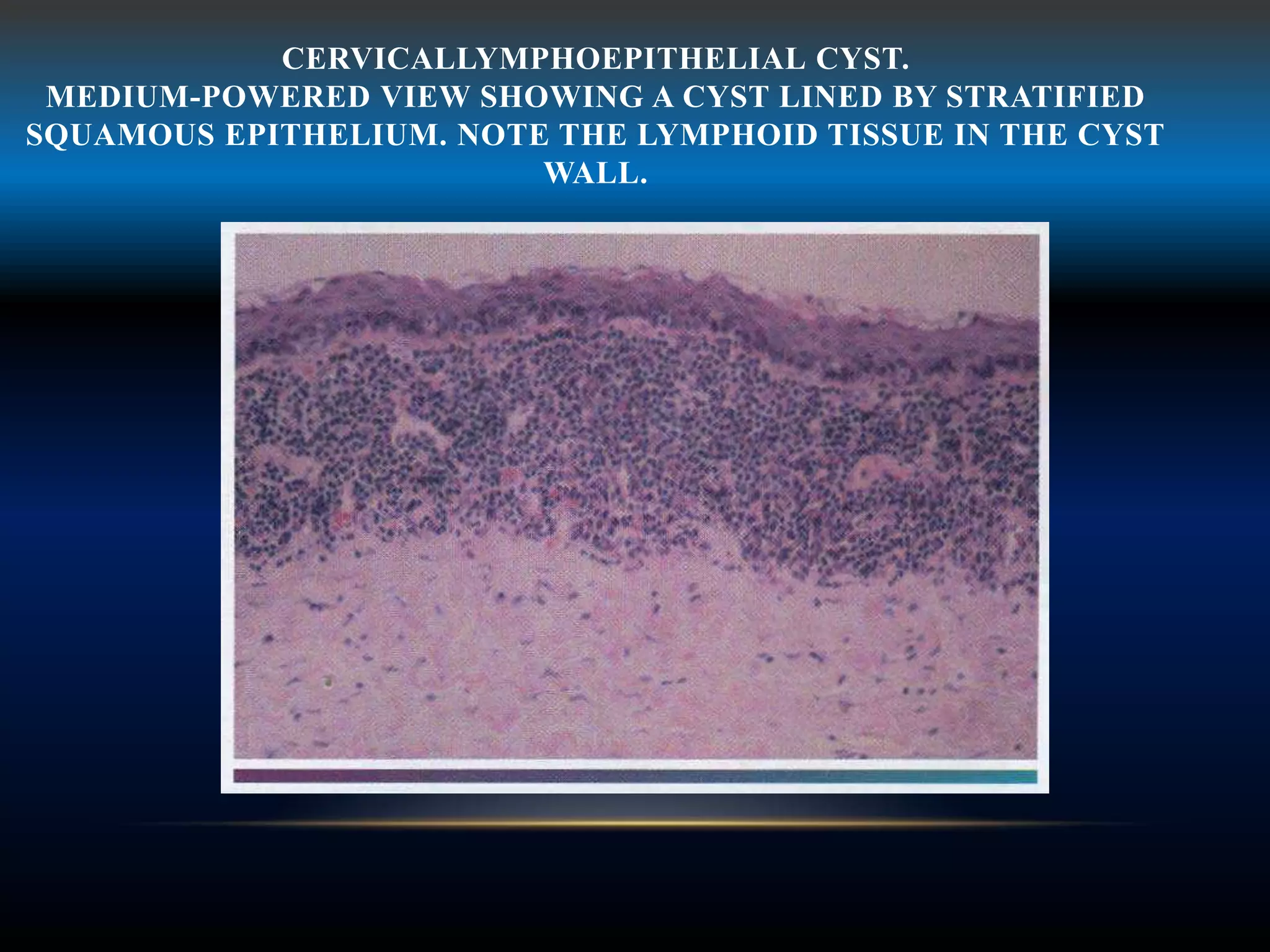 CERVICALLYMPHOEPITHELIAL CYST.
MEDIUM-POWERED VIEW SHOWING A CYST LINED BY STRATIFIED
SQUAMOUS EPITHELIUM. NOTE THE LYMPHOID TISSUE IN THE CYST
WALL.
 