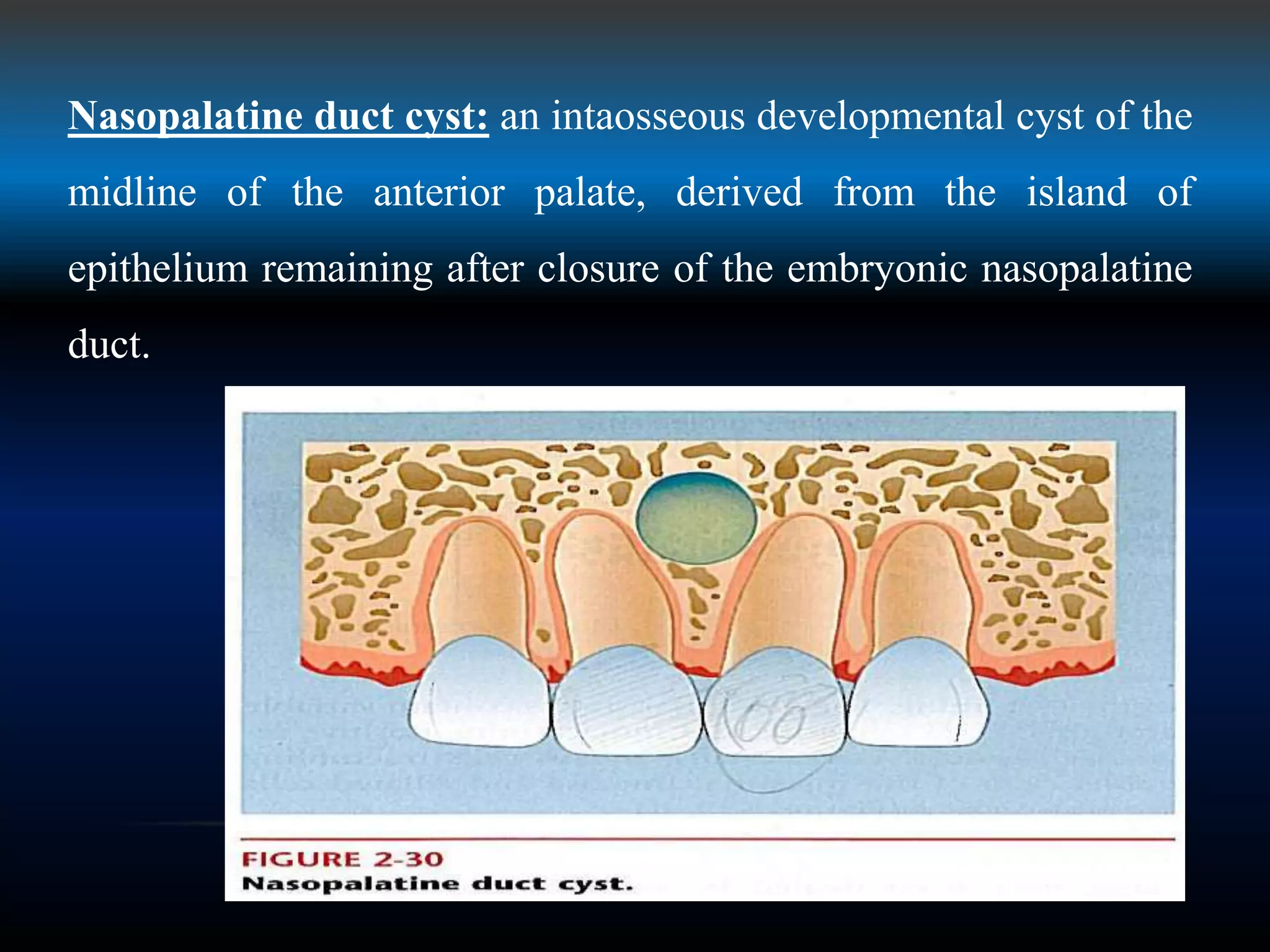 Nasopalatine duct cyst: an intaosseous developmental cyst of the
midline of the anterior palate, derived from the island of
epithelium remaining after closure of the embryonic nasopalatine
duct.
 