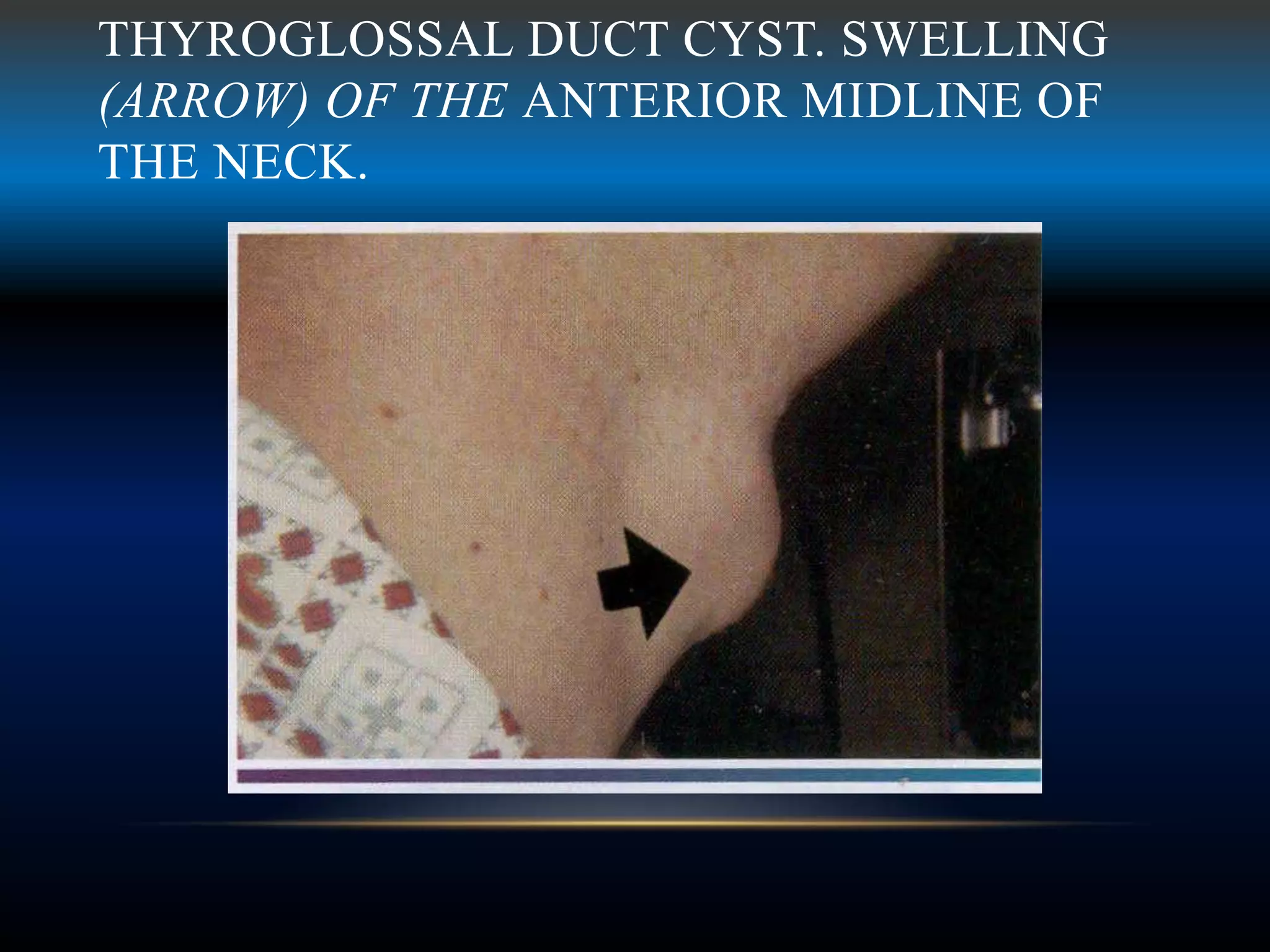 THYROGLOSSAL DUCT CYST. SWELLING
(ARROW) OF THE ANTERIOR MIDLINE OF
THE NECK.
 