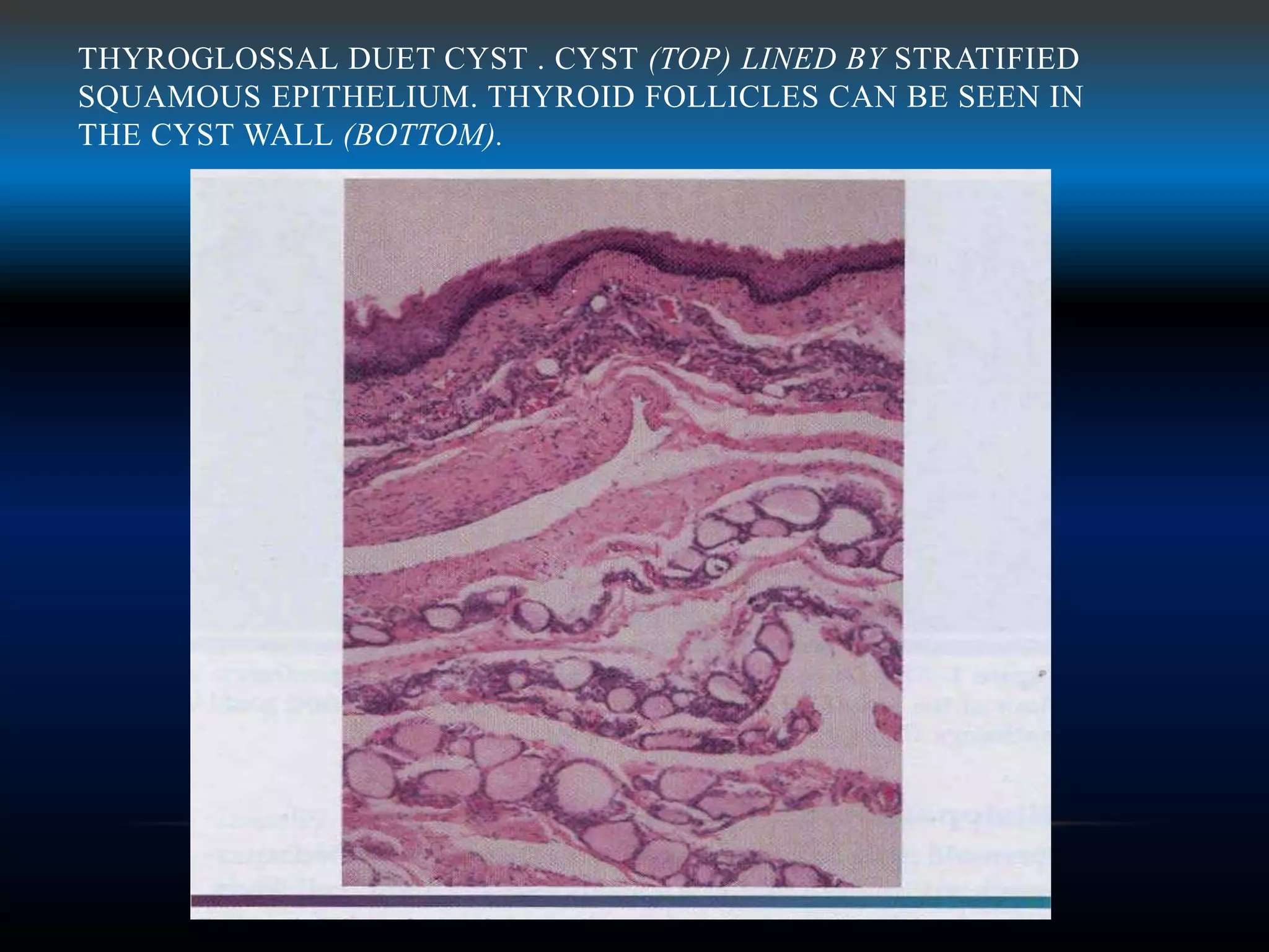 THYROGLOSSAL DUET CYST . CYST (TOP) LINED BY STRATIFIED
SQUAMOUS EPITHELIUM. THYROID FOLLICLES CAN BE SEEN IN
THE CYST WALL (BOTTOM).
 