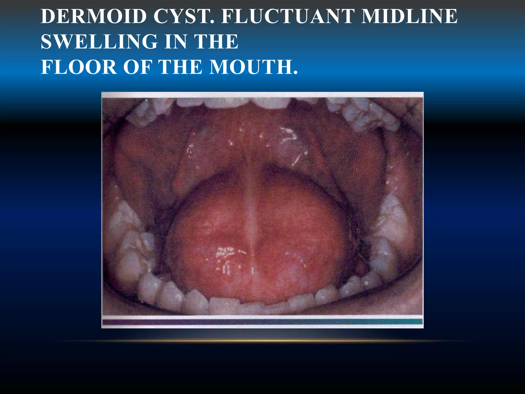 DERMOID CYST. FLUCTUANT MIDLINE
SWELLING IN THE
FLOOR OF THE MOUTH.
 