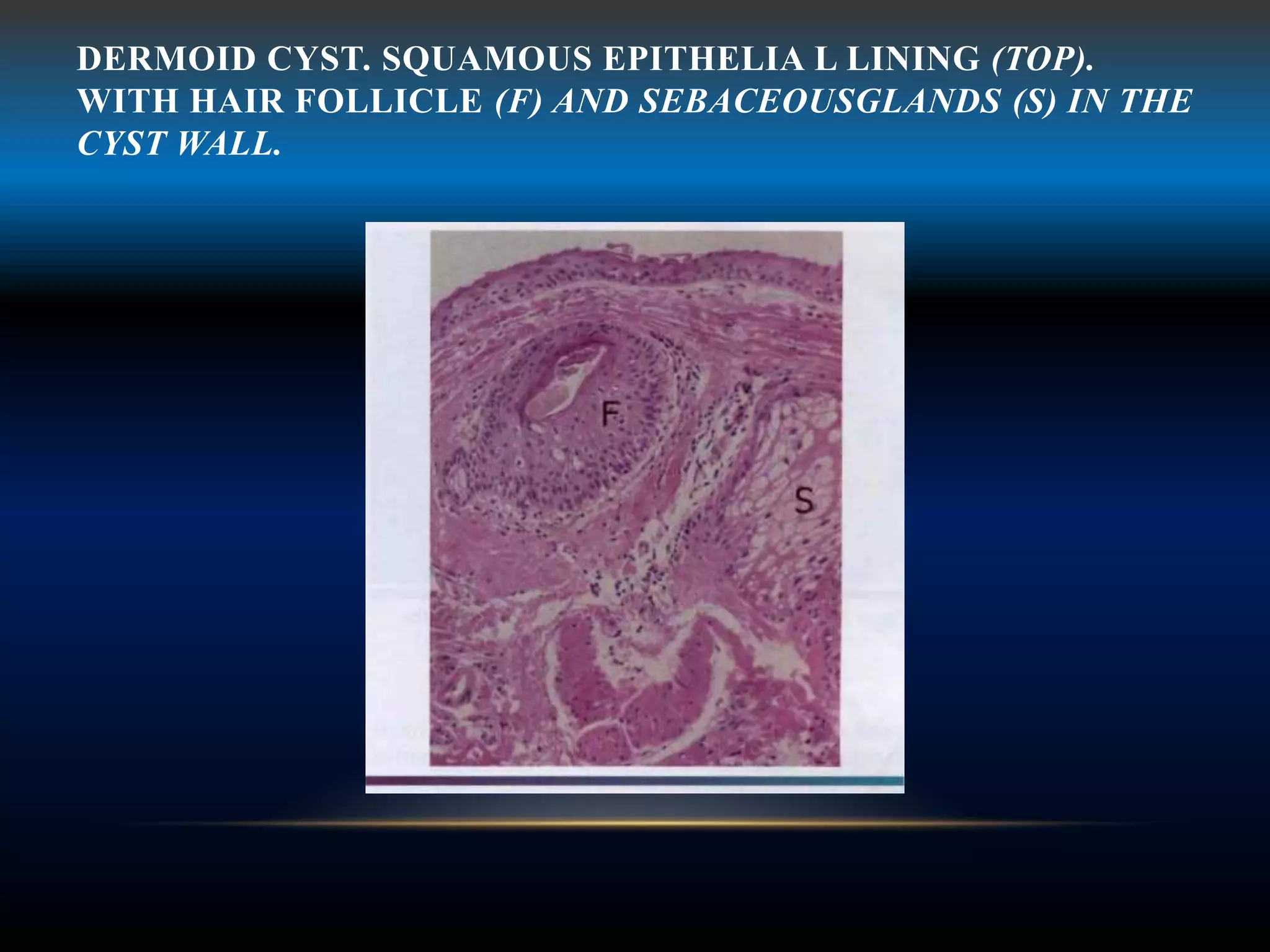 DERMOID CYST. SQUAMOUS EPITHELIA L LINING (TOP).
WITH HAIR FOLLICLE (F) AND SEBACEOUSGLANDS (S) IN THE
CYST WALL.
 
