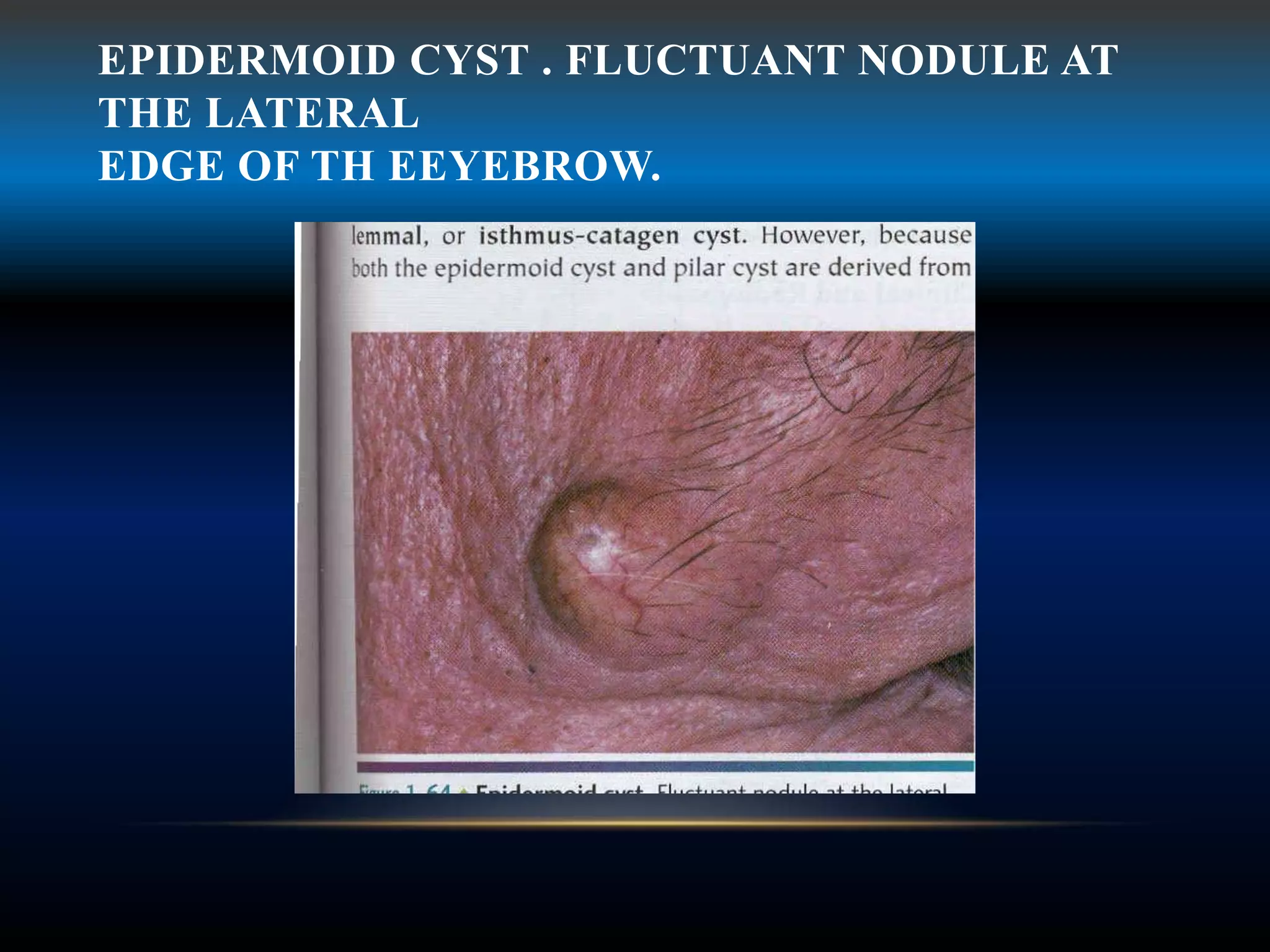 EPIDERMOID CYST . FLUCTUANT NODULE AT
THE LATERAL
EDGE OF TH EEYEBROW.
 