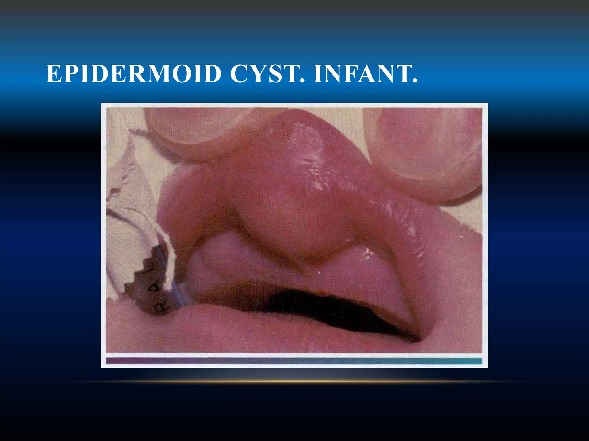 EPIDERMOID CYST. INFANT.
 
