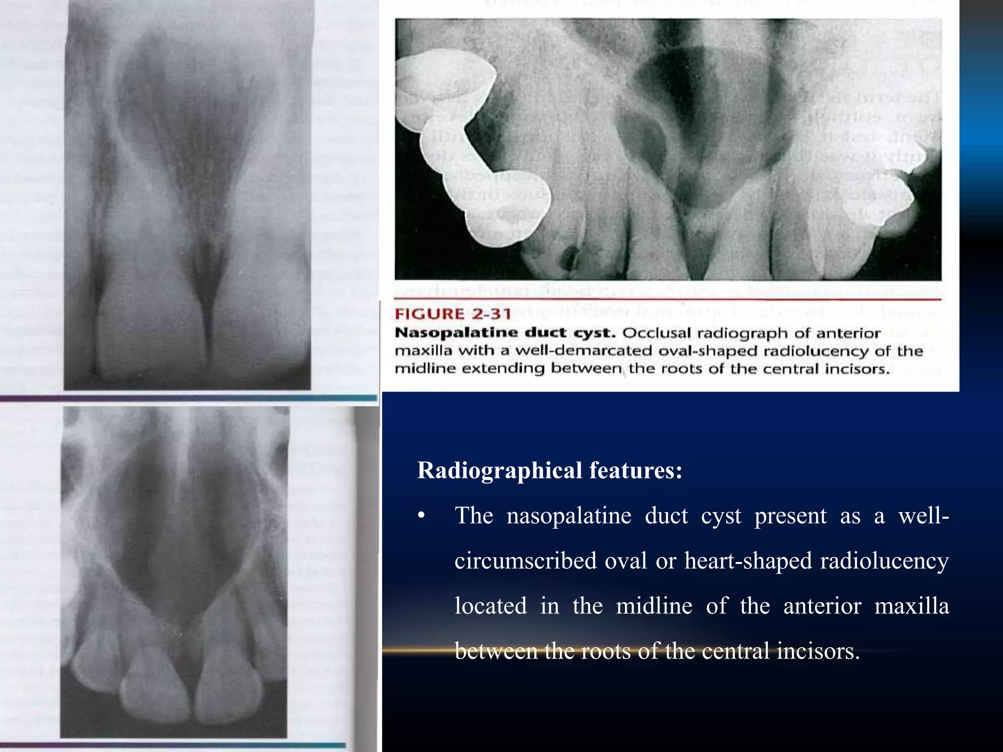 Radiographical features:
• The nasopalatine duct cyst present as a well-
circumscribed oval or heart-shaped radiolucency
located in the midline of the anterior maxilla
between the roots of the central incisors.
 