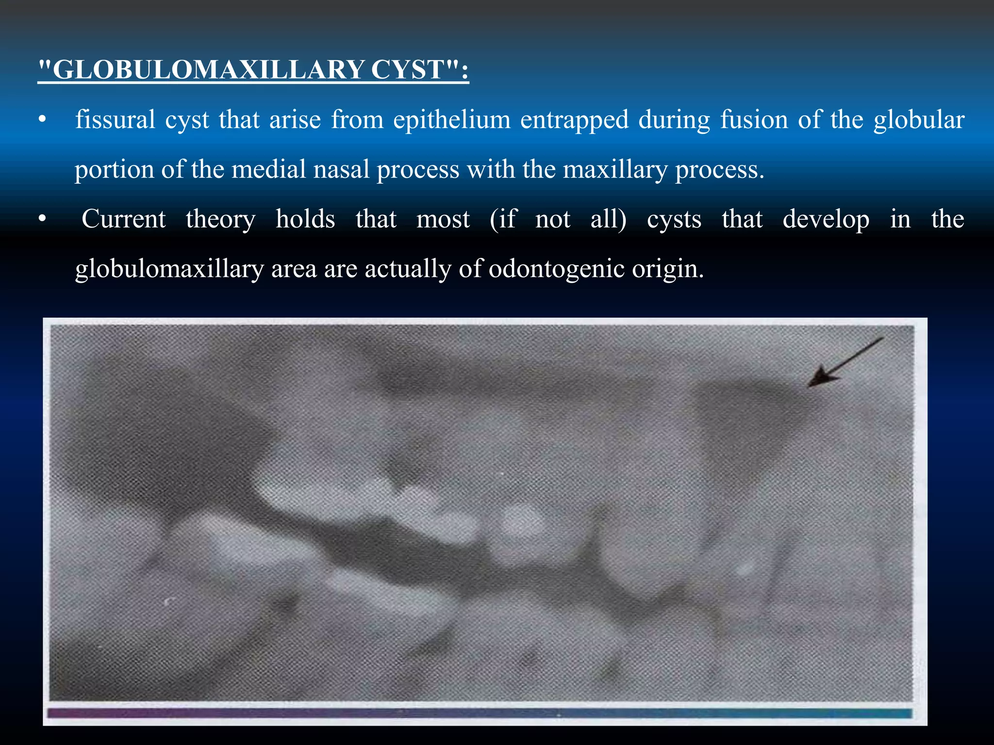 "GLOBULOMAXILLARY CYST":
• fissural cyst that arise from epithelium entrapped during fusion of the globular
portion of the medial nasal process with the maxillary process.
• Current theory holds that most (if not all) cysts that develop in the
globulomaxillary area are actually of odontogenic origin.
 