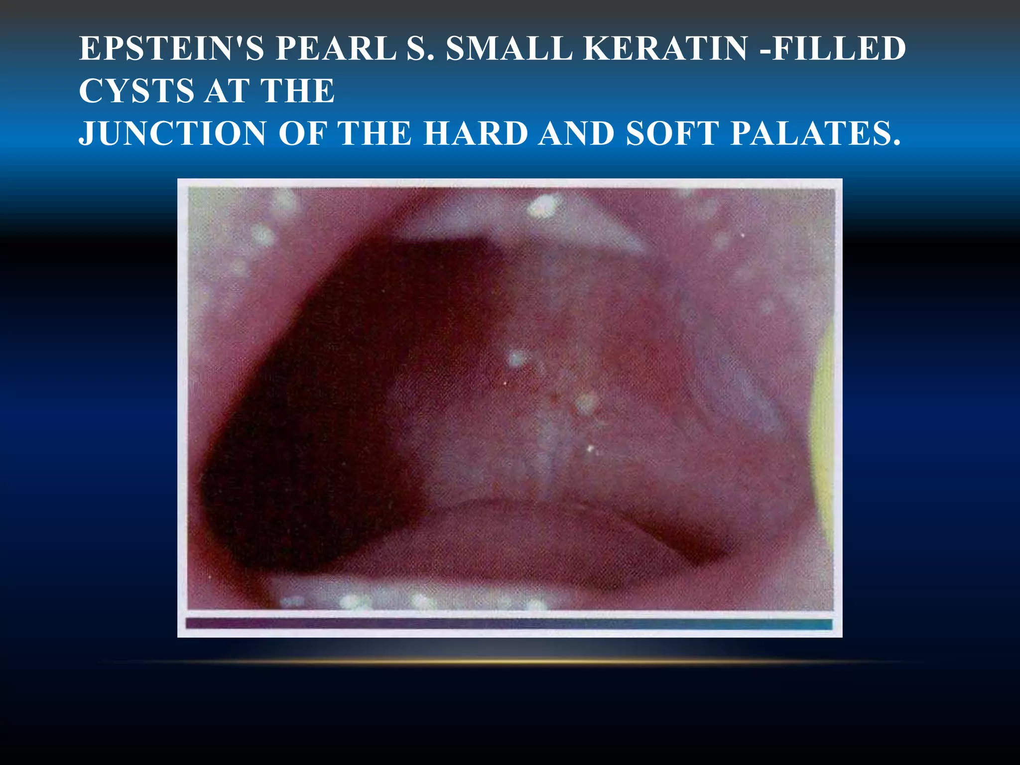 EPSTEIN'S PEARL S. SMALL KERATIN -FILLED
CYSTS AT THE
JUNCTION OF THE HARD AND SOFT PALATES.
 