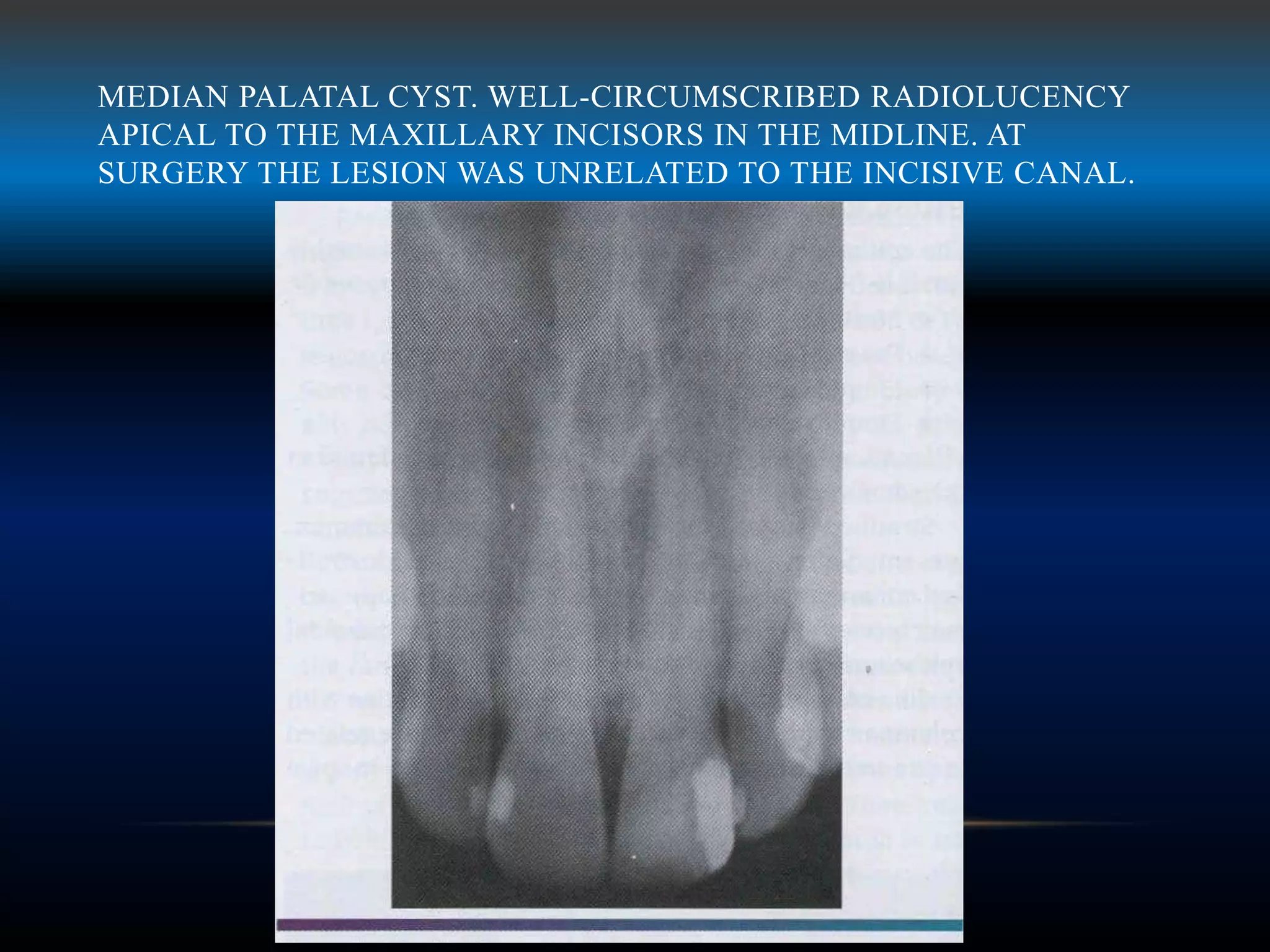 MEDIAN PALATAL CYST. WELL-CIRCUMSCRIBED RADIOLUCENCY
APICAL TO THE MAXILLARY INCISORS IN THE MIDLINE. AT
SURGERY THE LESION WAS UNRELATED TO THE INCISIVE CANAL.
 