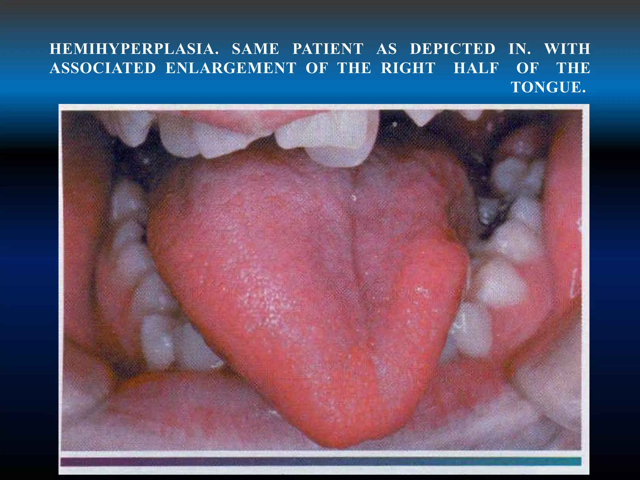 HEMIHYPERPLASIA. SAME PATIENT AS DEPICTED IN. WITH
ASSOCIATED ENLARGEMENT OF THE RIGHT HALF OF THE
TONGUE.
 