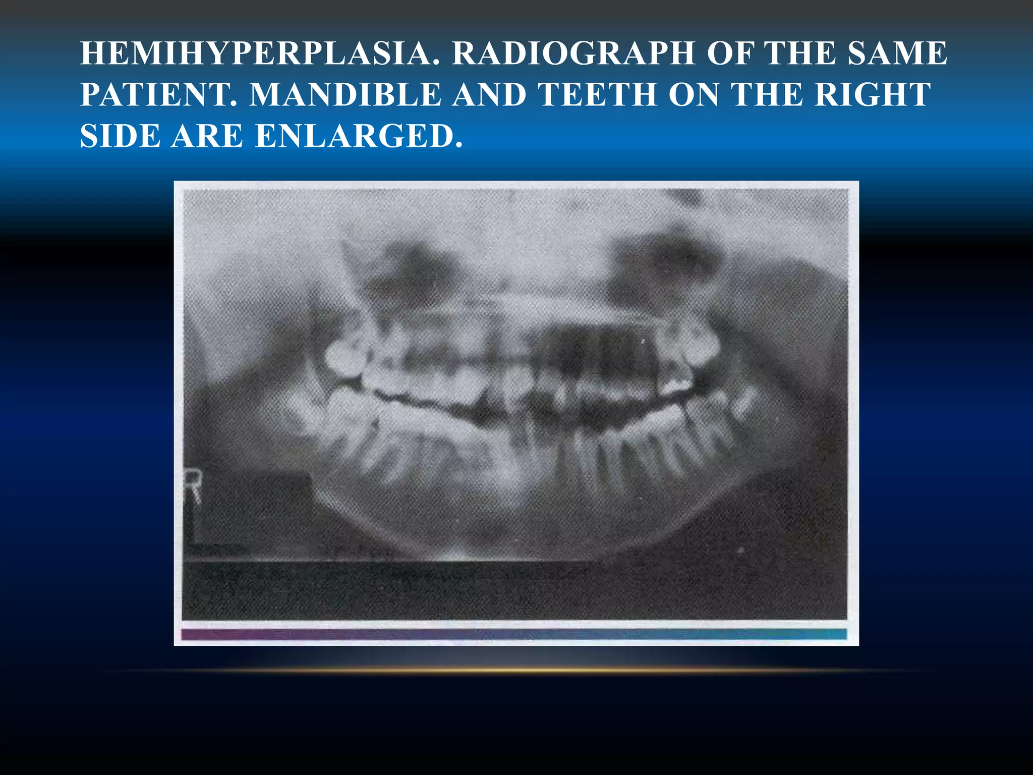 HEMIHYPERPLASIA. RADIOGRAPH OF THE SAME
PATIENT. MANDIBLE AND TEETH ON THE RIGHT
SIDE ARE ENLARGED.
 