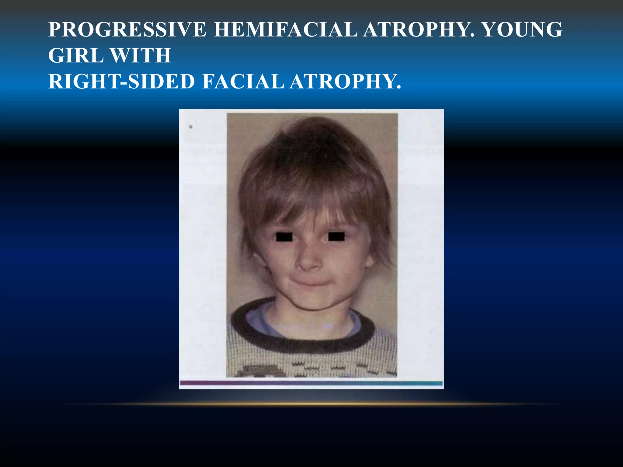 PROGRESSIVE HEMIFACIAL ATROPHY. YOUNG
GIRL WITH
RIGHT-SIDED FACIAL ATROPHY.
 