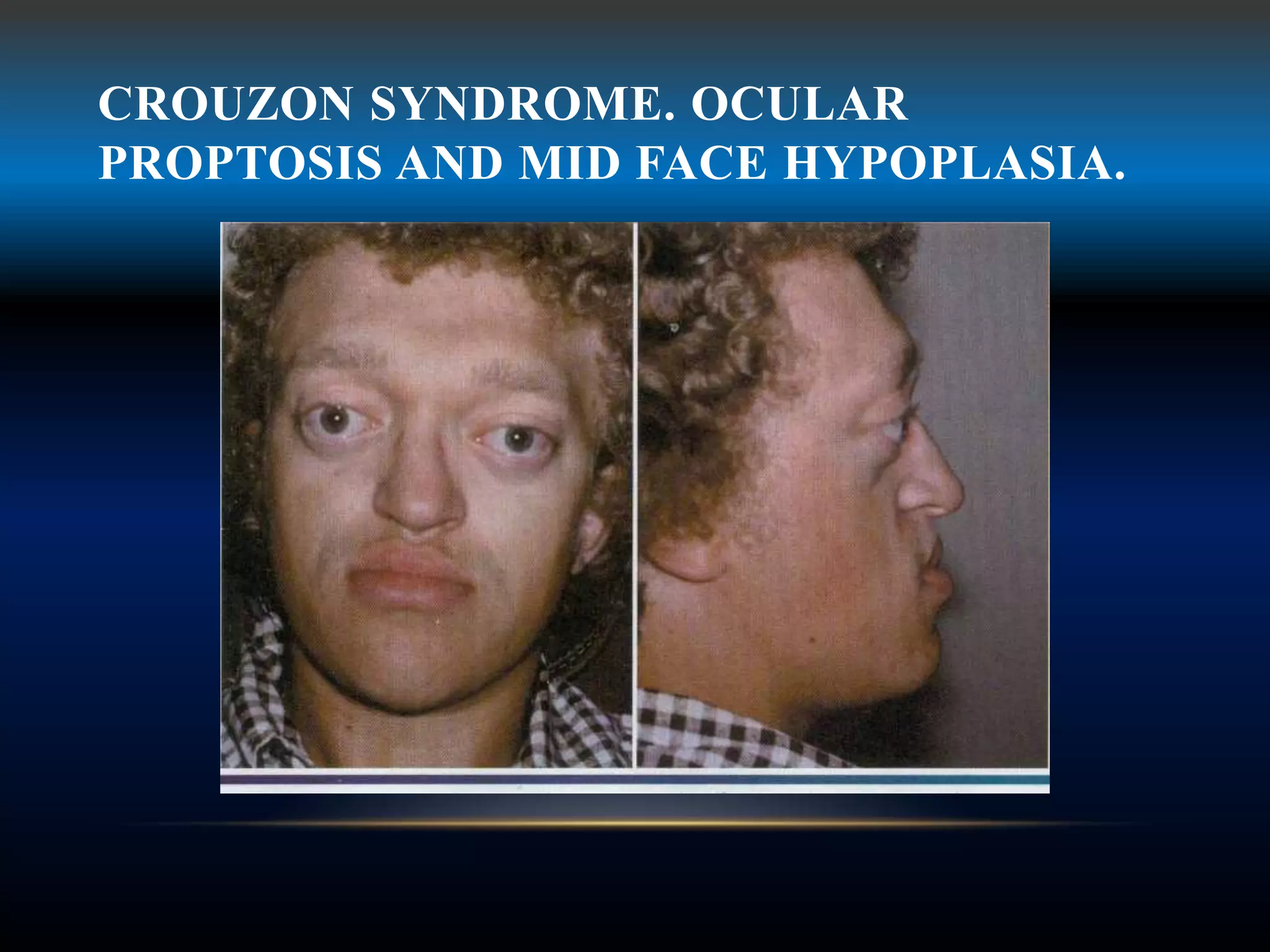 CROUZON SYNDROME. OCULAR
PROPTOSIS AND MID FACE HYPOPLASIA.
 