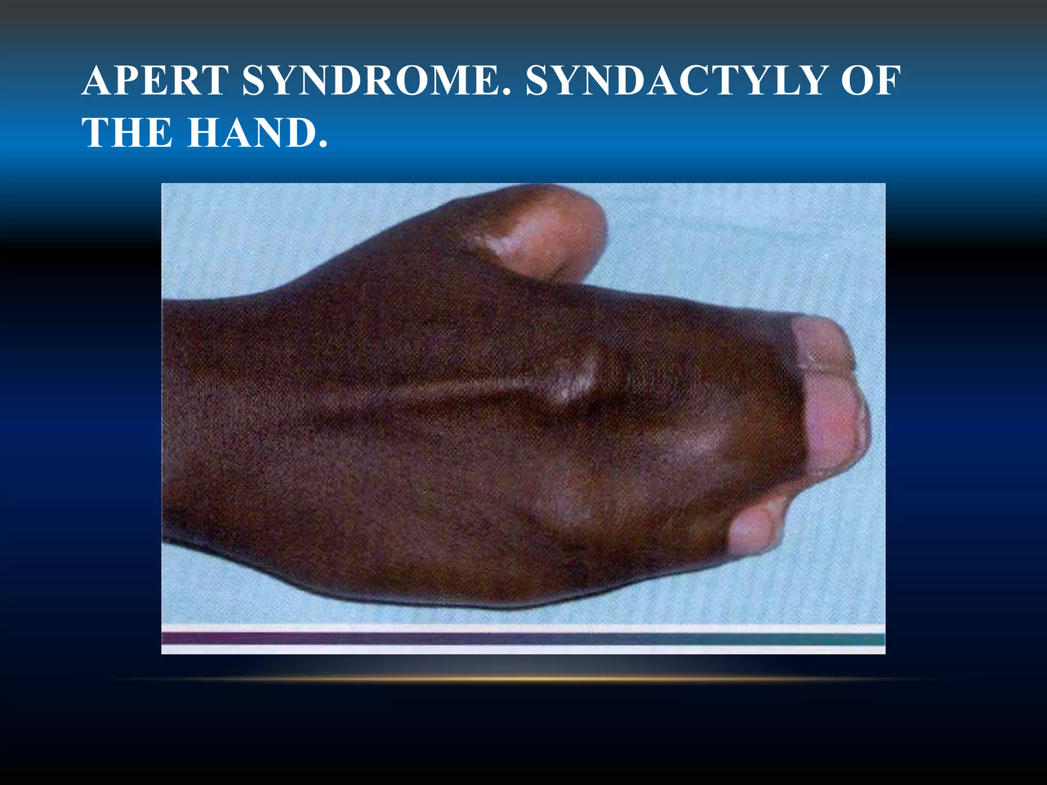 APERT SYNDROME. SYNDACTYLY OF
THE HAND.
 