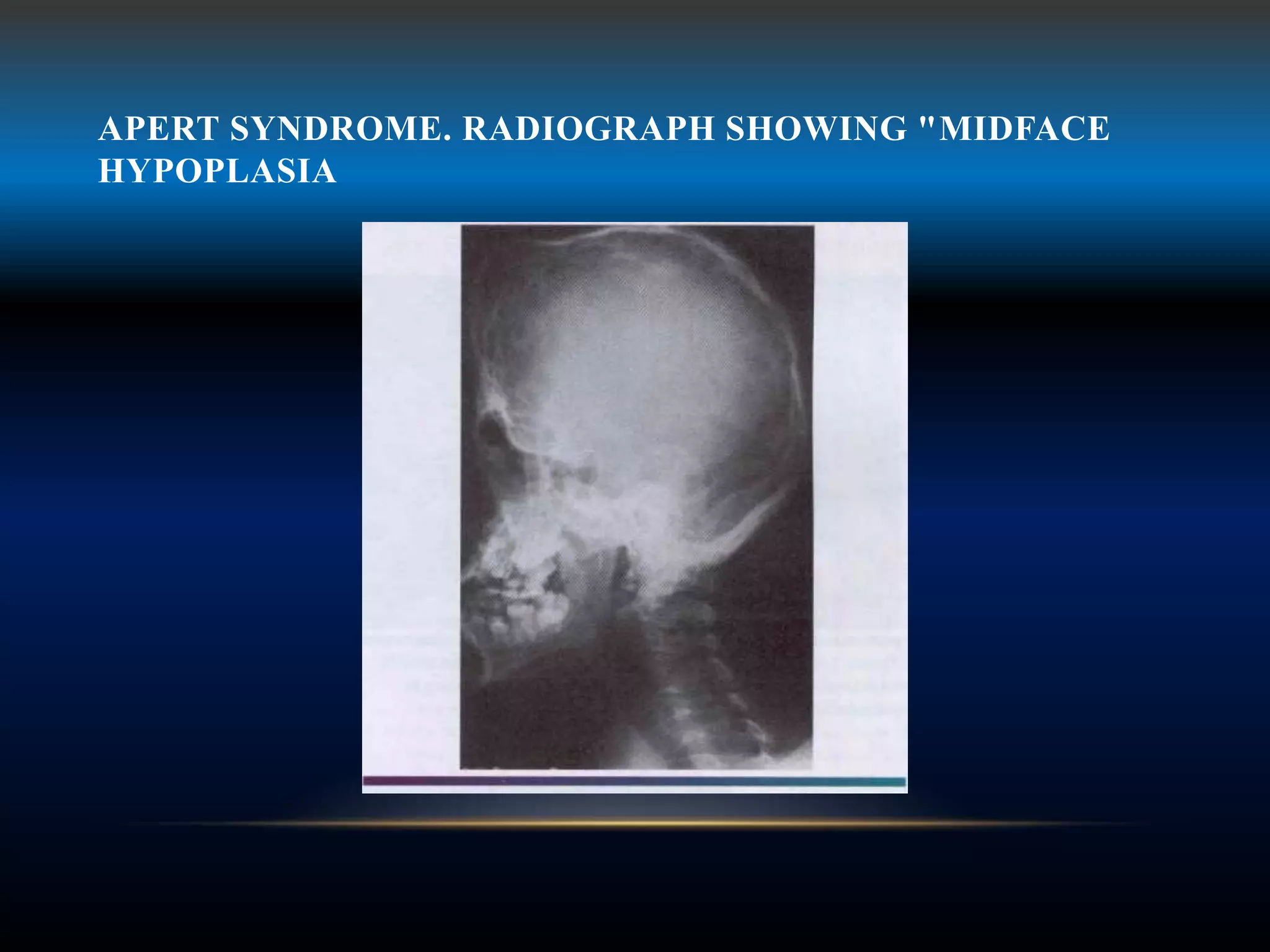 APERT SYNDROME. RADIOGRAPH SHOWING "MIDFACE
HYPOPLASIA
 