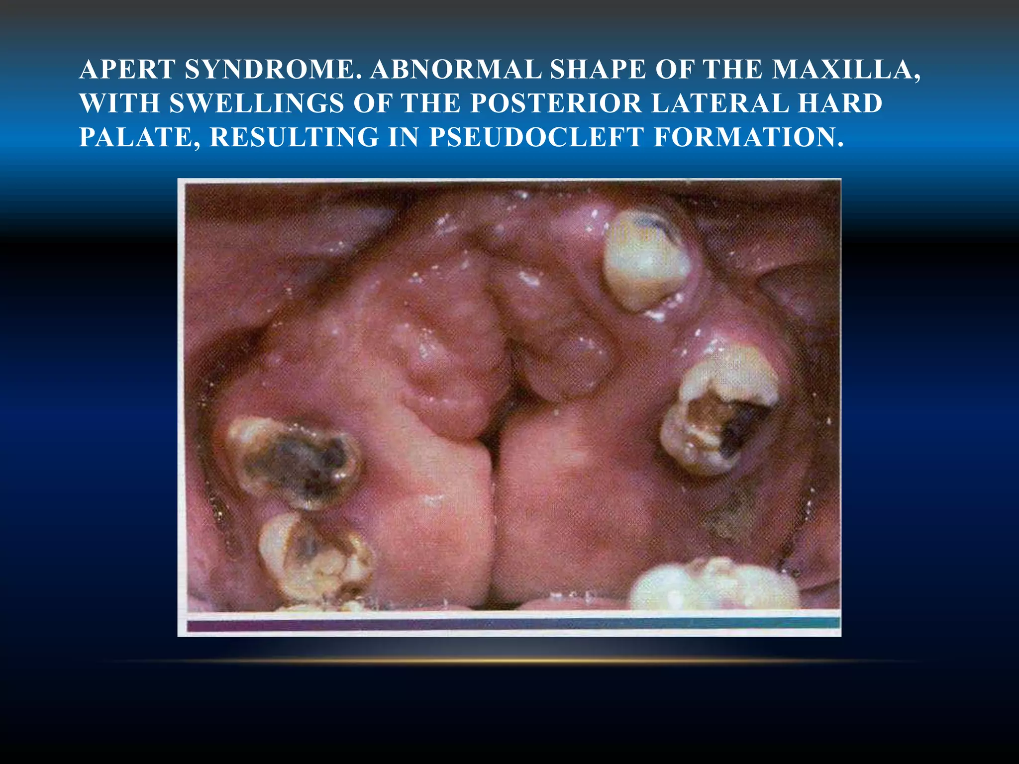 APERT SYNDROME. ABNORMAL SHAPE OF THE MAXILLA,
WITH SWELLINGS OF THE POSTERIOR LATERAL HARD
PALATE, RESULTING IN PSEUDOCLEFT FORMATION.
 