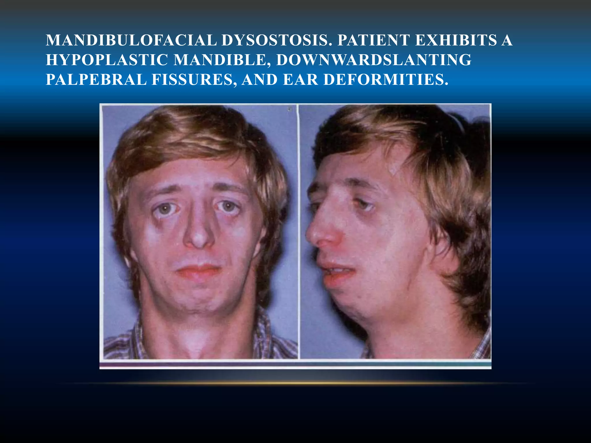 MANDIBULOFACIAL DYSOSTOSIS. PATIENT EXHIBITS A
HYPOPLASTIC MANDIBLE, DOWNWARDSLANTING
PALPEBRAL FISSURES, AND EAR DEFORMITIES.
 