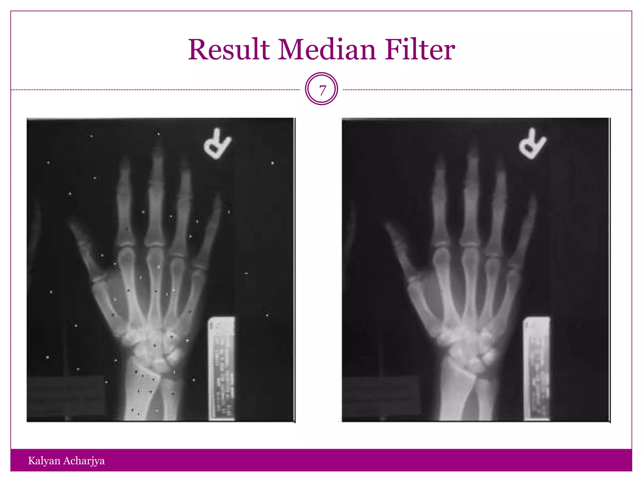 Result Median Filter
7
Kalyan Acharjya
 
