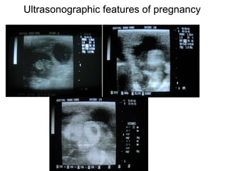 Ultrasonographic features of pregnancy
 