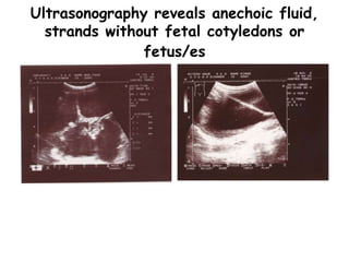 Ultrasonography reveals anechoic fluid,
strands without fetal cotyledons or
fetus/es
 