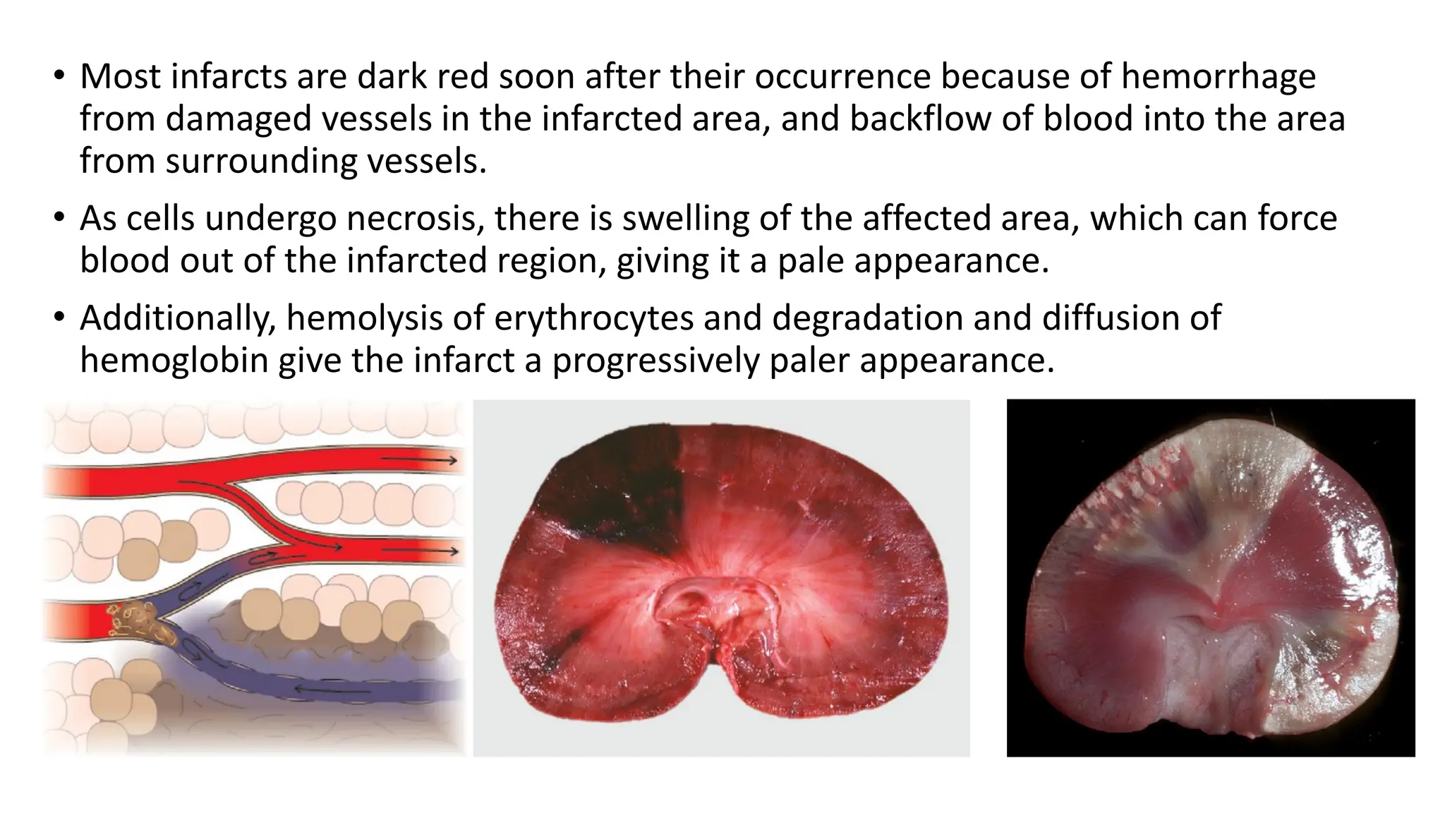 • Most infarcts are dark red soon after their occurrence because of hemorrhage
from damaged vessels in the infarcted area, and backflow of blood into the area
from surrounding vessels.
• As cells undergo necrosis, there is swelling of the affected area, which can force
blood out of the infarcted region, giving it a pale appearance.
• Additionally, hemolysis of erythrocytes and degradation and diffusion of
hemoglobin give the infarct a progressively paler appearance.
 