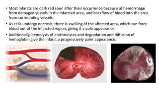 Lecture # 15, Ischemia and Infarction.pdf