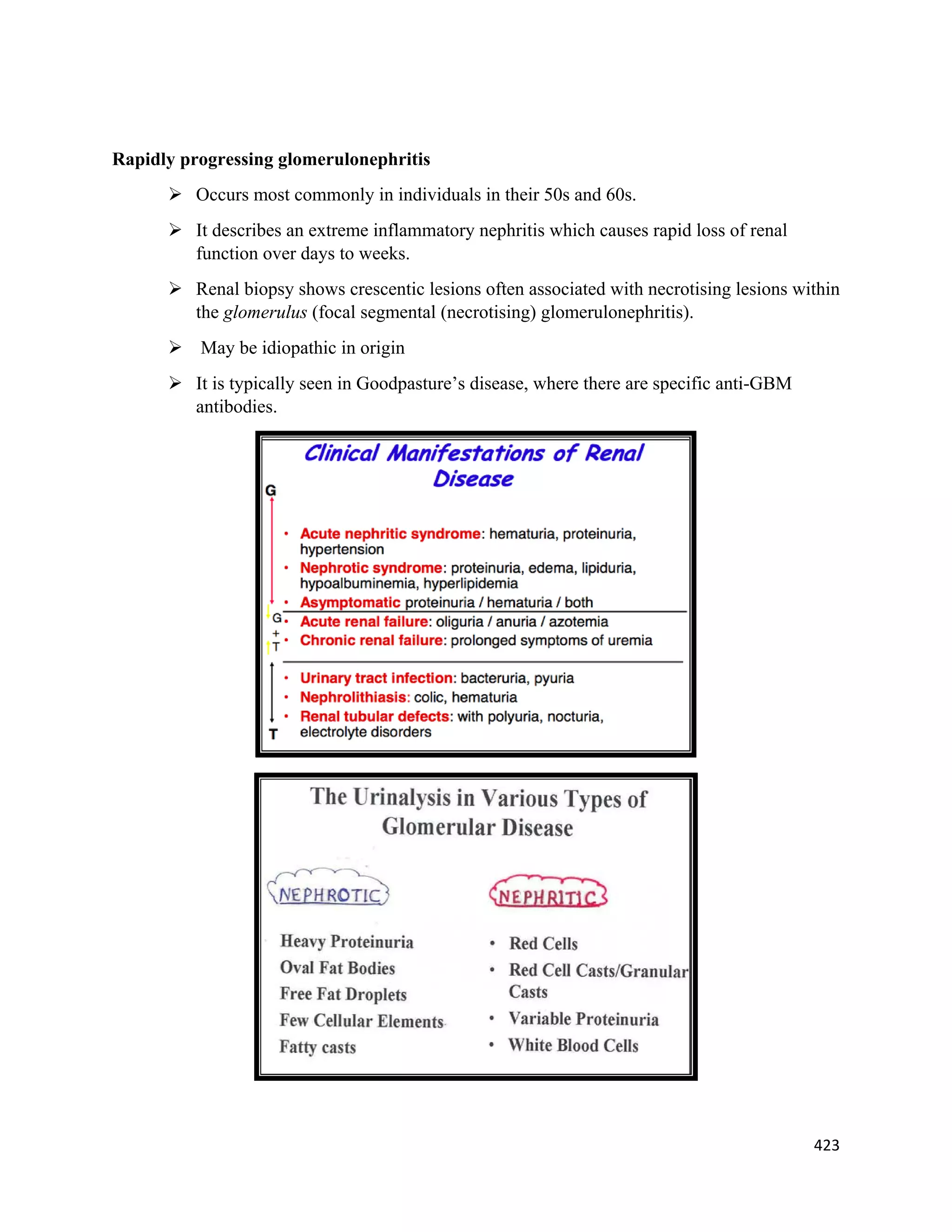 423 
 
Rapidly progressing glomerulonephritis
 Occurs most commonly in individuals in their 50s and 60s.
 It describes an extreme inflammatory nephritis which causes rapid loss of renal
function over days to weeks.
 Renal biopsy shows crescentic lesions often associated with necrotising lesions within
the glomerulus (focal segmental (necrotising) glomerulonephritis).
 May be idiopathic in origin
 It is typically seen in Goodpasture’s disease, where there are specific anti-GBM
antibodies.
 