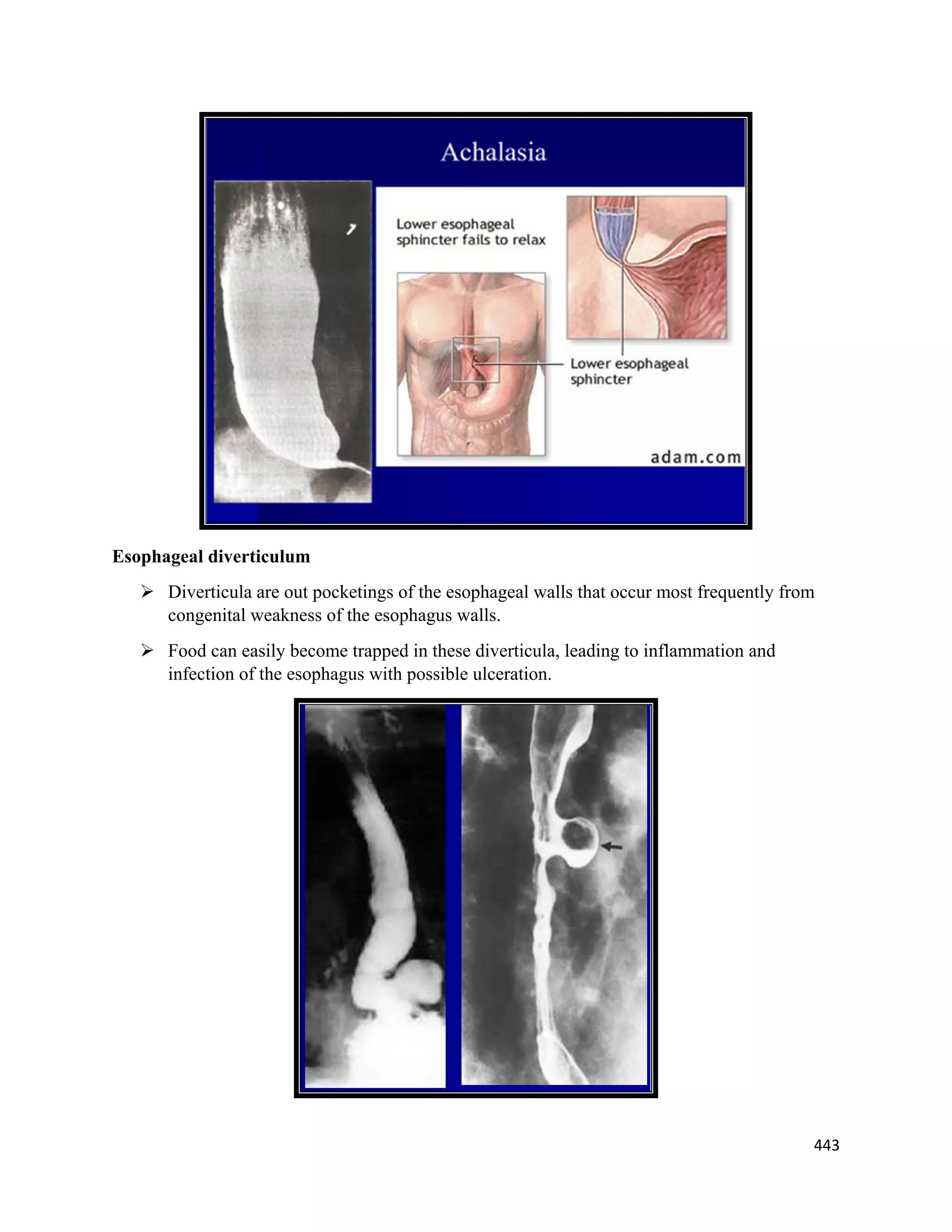 Lecture 16 esophagus and stomach disorders - Pathology | PDF