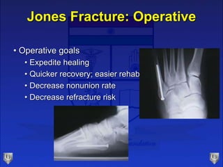 Jones Fracture: Operative
• Operative goals
• Expedite healing
• Quicker recovery; easier rehab
• Decrease nonunion rate
• Decrease refracture risk
 
