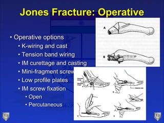 Jones Fracture: Operative
• Operative options
• K-wiring and cast
• Tension band wiring
• IM curettage and casting
• Mini-fragment screws
• Low profile plates
• IM screw fixation
• Open
• Percutaneous
 