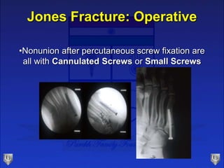 Jones Fracture: Operative
•Nonunion after percutaneous screw fixation are
all with Cannulated Screws or Small Screws
 