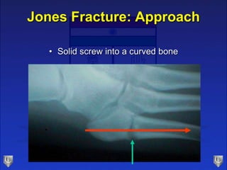 Jones Fracture: Approach
• Solid screw into a curved bone
 