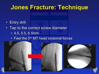 Jones Fracture: Technique
• Entry drill
• Tap to the correct screw diameter
• 4.5, 5.5, 6.5mm
• Feel the 5th MT head torsional forces
 