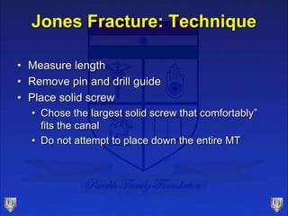 Jones Fracture: Technique
• Measure length
• Remove pin and drill guide
• Place solid screw
• Chose the largest solid screw that comfortably”
fits the canal
• Do not attempt to place down the entire MT
 