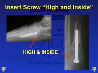 Insert Screw “High and Inside”
HIGH & INSIDE
 