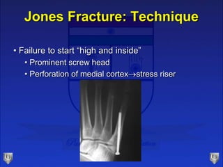 Jones Fracture: Technique
• Failure to start “high and inside”
• Prominent screw head
• Perforation of medial cortexstress riser
 