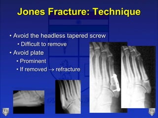 Jones Fracture: Technique
• Avoid the headless tapered screw
• Difficult to remove
• Avoid plate
• Prominent
• If removed  refracture
 