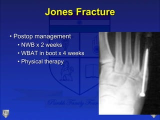 Jones Fracture
• Postop management
• NWB x 2 weeks
• WBAT in boot x 4 weeks
• Physical therapy
 