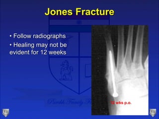 Jones Fracture
• Follow radiographs
• Healing may not be
evident for 12 weeks
12 wks p.o.
 