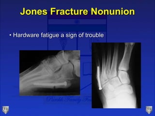 Jones Fracture Nonunion
• Hardware fatigue a sign of trouble
 