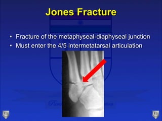 Jones Fracture
• Fracture of the metaphyseal-diaphyseal junction
• Must enter the 4/5 intermetatarsal articulation
 