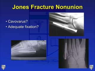Jones Fracture Nonunion
• Cavovarus?
• Adequate fixation?
 