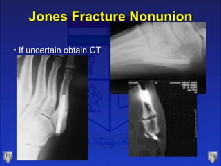 Jones Fracture Nonunion
• If uncertain obtain CT
 