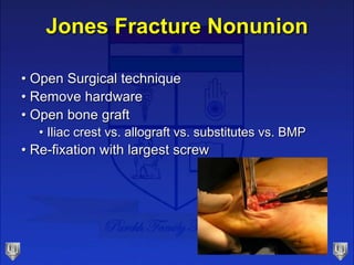 Jones Fracture Nonunion
• Open Surgical technique
• Remove hardware
• Open bone graft
• Iliac crest vs. allograft vs. substitutes vs. BMP
• Re-fixation with largest screw
 